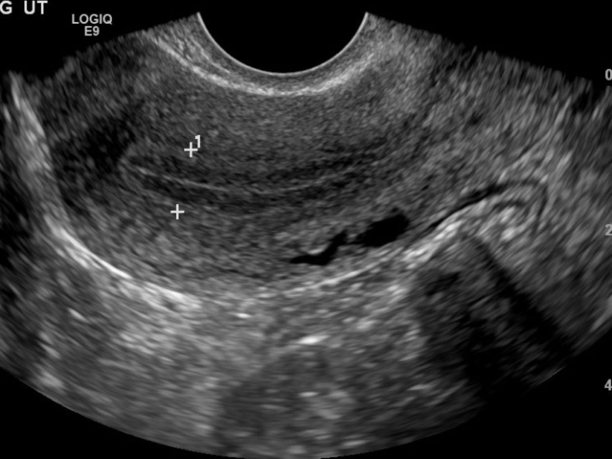 Abnormal Uterus Ultrasound